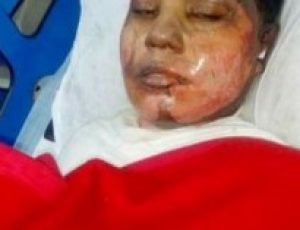 Pakistani Christian girl dies after having acid thrown on her and being set alight